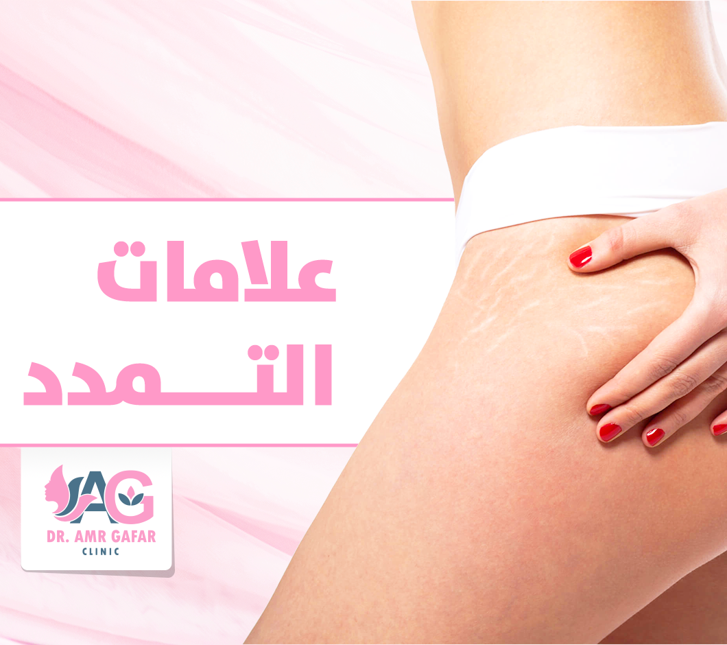 علامات التمدد