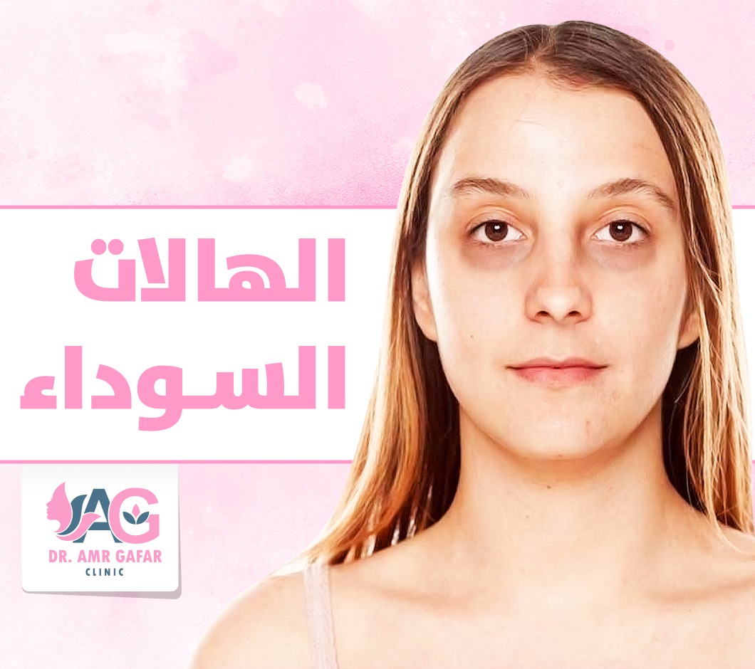 كيفية التعامل مع الهالات السوداء 