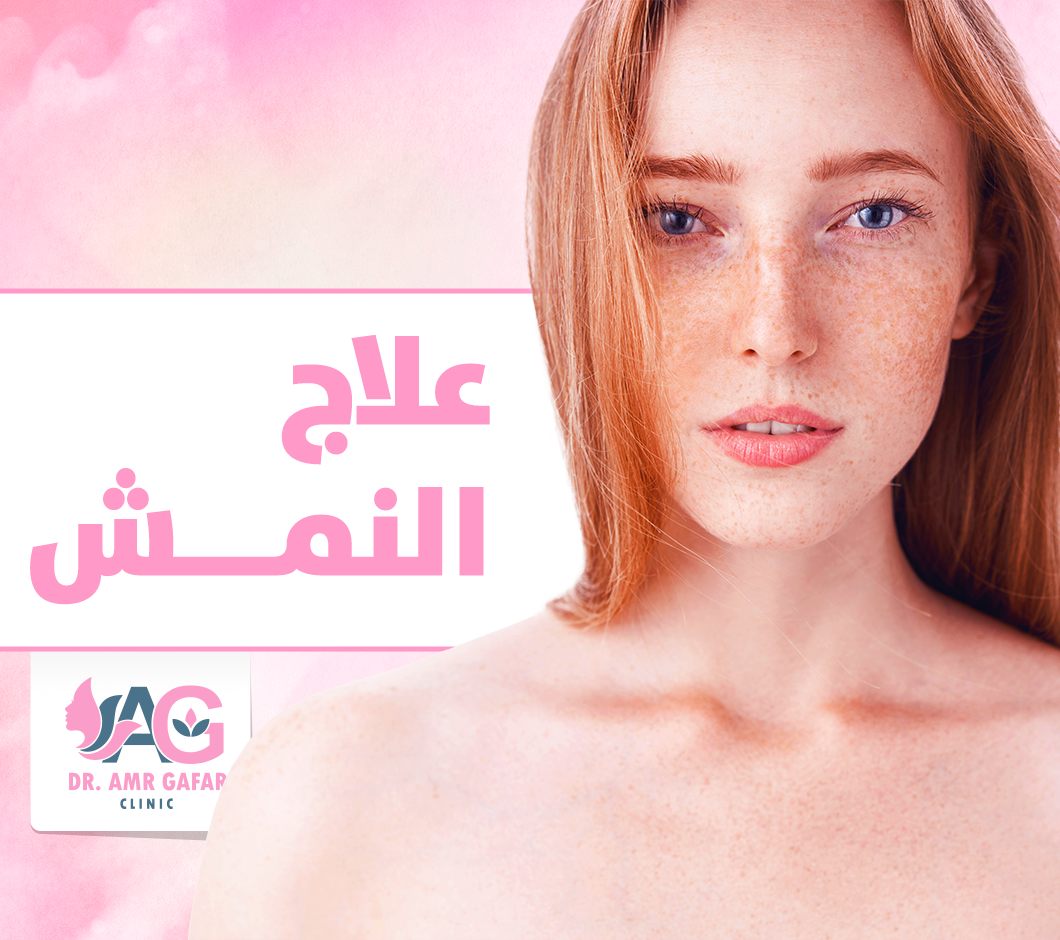 ماهو علاج النمش؟