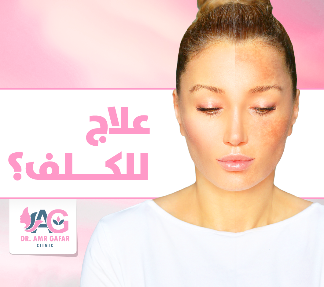 هل يوجد علاج للكلف؟ 