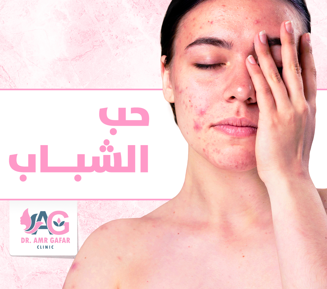 طريقة التعامل مع حب الشباب 